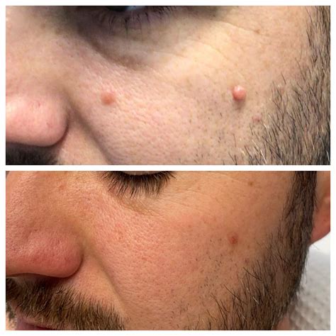 Shaved Mole Removal, [B&A] [Selfie] R/SkincareAddiction, 54% OFF