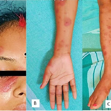 (A, B and C) erythematous edematous tender plaques of variable sizes... | Download Scientific ...