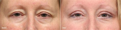 Upper Eyelid Surgery Photos | Princeton, NJ | Patient 9374