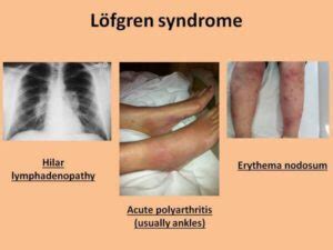 Lofgren Syndrome: Causes, Symptoms, & Treatment - Daily Medicos