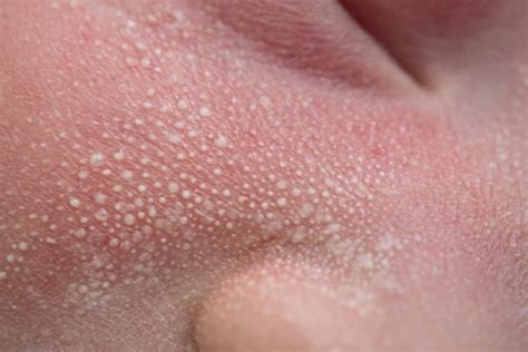 Milia in Newborns: Understanding These Little White Bumps - Riverchase Dermatology