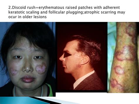 PPT - Systemic Lupus Erythematosus PowerPoint Presentation, free download - ID:6874289