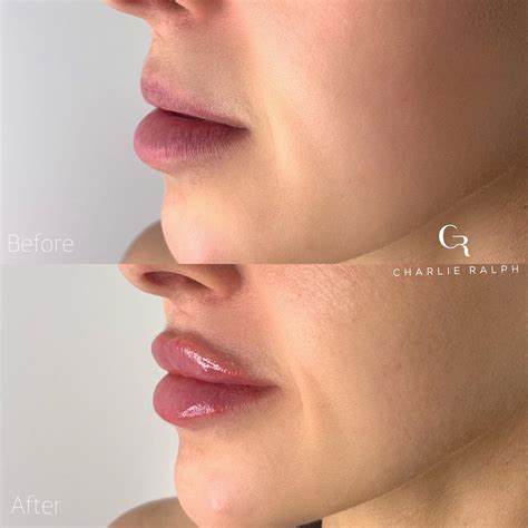 Lip Filler Before and After: Enhancing Your Top Lip