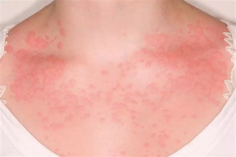 Why Do I Have A Rash Near My Armpit at Dale King blog