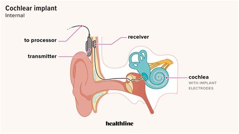 Cochlear Implant: Cost, Pros, Cons, Risks, How It Works