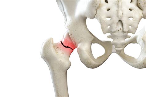 Diagnose a hip fracture | Treatment of hip fracture at Zehr Center