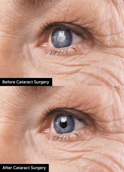 Tottenham: [View 27+] Glasses For One Eye After Cataract Surgery