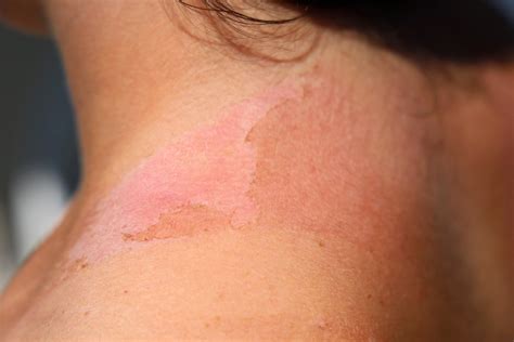 Sunburn Skin Cancer What You Should Know - vrogue.co