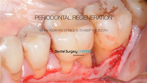 PERIODONTAL REGENERATION. PERIODONTOLOGY COURSE PART 1 - dentalsurgerychannel.com