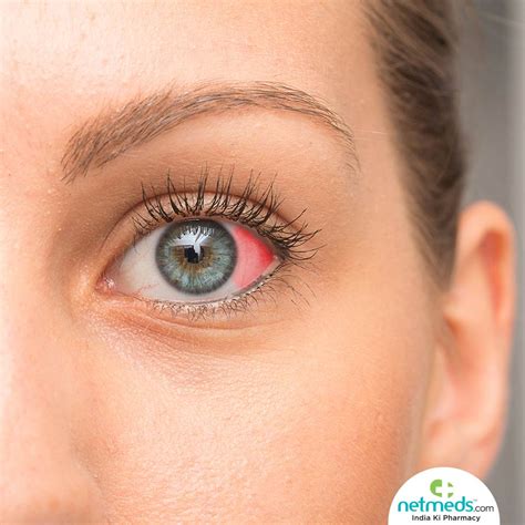 Red Dots Under Eyes - Kidney Disease Dialysis And Your Eyes National Kidney Foundation - Factors ...