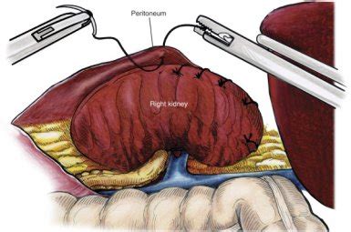 NEPHROPEXY | Master Clínica