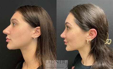 Rhinoplasty (Nose job) Before and After Pictures Case 168 | Denver, CO ...