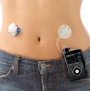 espada Ahuyentar Pakistán guardian sensor medtronic insondable Borradura Arqueología