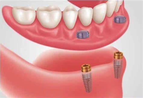 Full Mouth Implant Costs-Types of Teeth and the Prices
