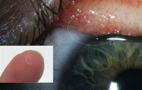 Woman discovers 14 parasitic worms in her eye - Insight