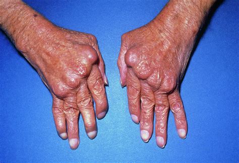 Hands With Rheumatoid Arthritis by James Stevenson/science Photo Library