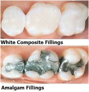 Dental Fillings | The Dental Arcade – Blog