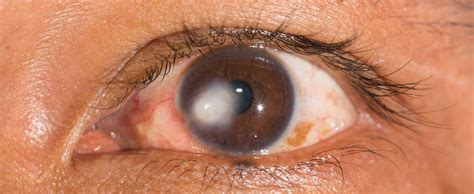 Ayurvedic Treatment for Corneal Scar | Corneal Scar ka ilaj