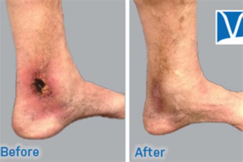 Ankle Discoloration - Inovia Vein Specialty Centers | Northwest Vein Treatment Clinics