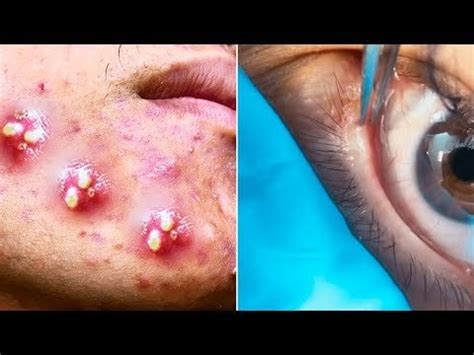 Popping Giant Pimple & Popping Huge Blackheads - Best Pimple Popping ...