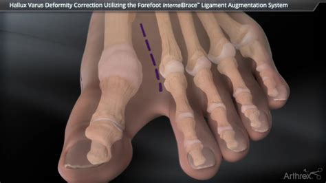 Arthrex - Hallux Varus Correction Using the Forefoot InternalBrace ...