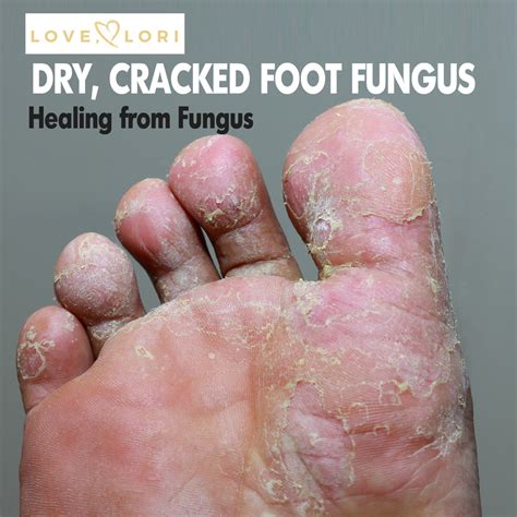 Hydrogen Peroxide Toenail Fungus Before And After - lvandcola