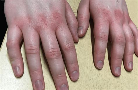 Possible Symptoms? : r/Erythromelalgia