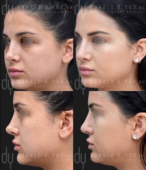 This gorgeous patient underwent revision rhinoplasty with rib cartilage with @drdonyoo to ...