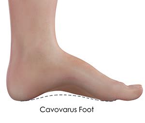 Cavovarus Foot Correction Bristol, TN | Cavovarus Foot Deformity Abingdon, VA