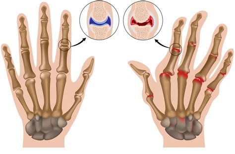 Early Osteoarthritis Hands