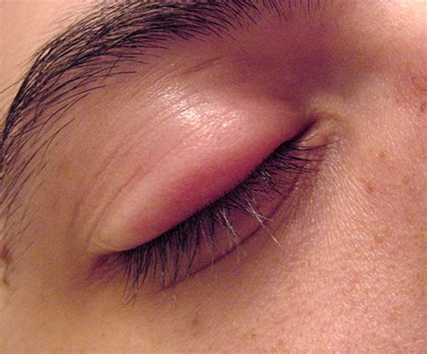 Eye Stye - Pictures, Treatment, Symptoms, Causes, Contagious