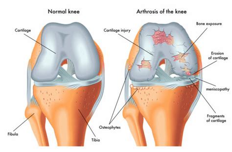 Cartilage treatments - Lyndon Bradley