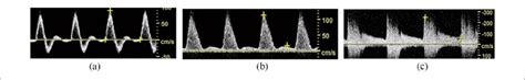 Spectral Doppler waveforms demonstrate (a) laminar, (b) disturbed, and... | Download Scientific ...