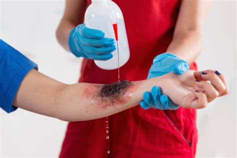 The Long-Term Effects of Chemical Burn Injuries | Misny Law