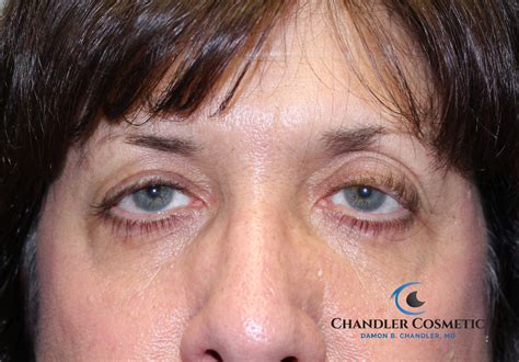 Ptosis Repair (Eyelid lift) for Droopy Eyelids - Chandler Cosmetic