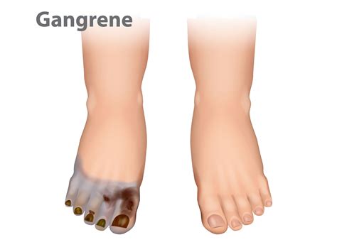 Gas Gangrene Hyperbaric Therapy - Under Pressure Hyperbarics