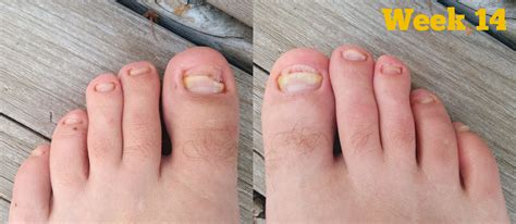 How To Get Rid Of Toenail Fungus: What Remedies Work | Toenail fungus remedies, Nail fungus ...