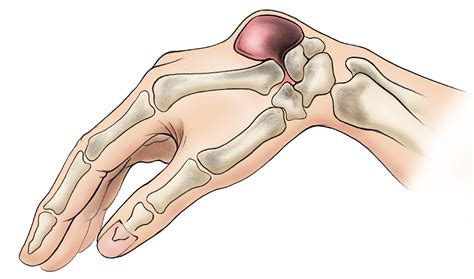 Quiste ganglionar de la muñeca y la mano (Ganglion Cyst of the Wrist ...