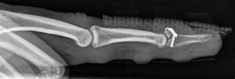 Mallet Finger • LITFL • Trauma Library