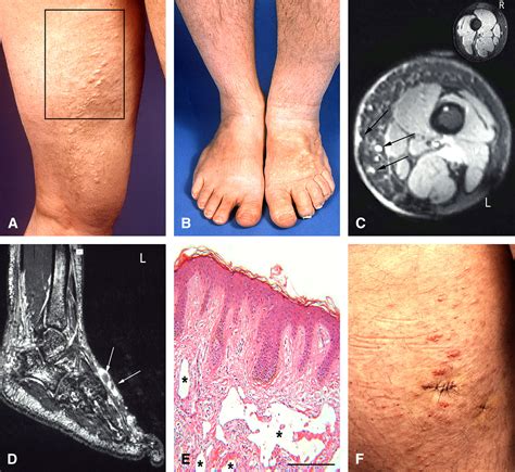 Cutaneous lymphatic malformations in disappearing bone (Gorham-Stout) disease: A novel clue to ...