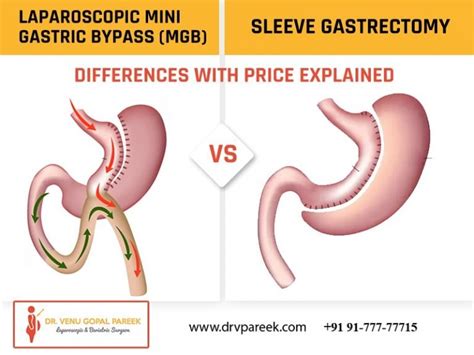 Laparoscopic Mini Gastric Bypass (MGB) vs Sleeve Gastrectomy ...