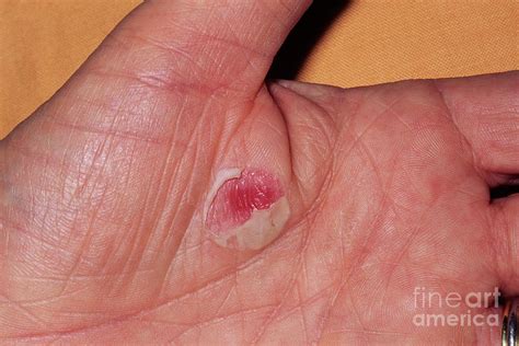 Burn Blister Photograph by Jane Shemilt/science Photo Library - Fine Art America