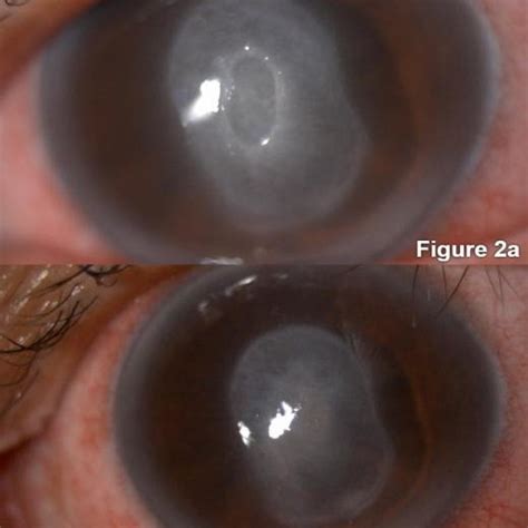 Anterior segment photograph showing: a) Central corneal infiltrate with ...