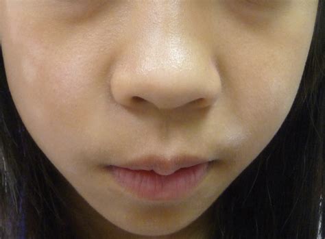 Hypopigmented Lesions on an 11-Year-Old’s Face | Consultant360