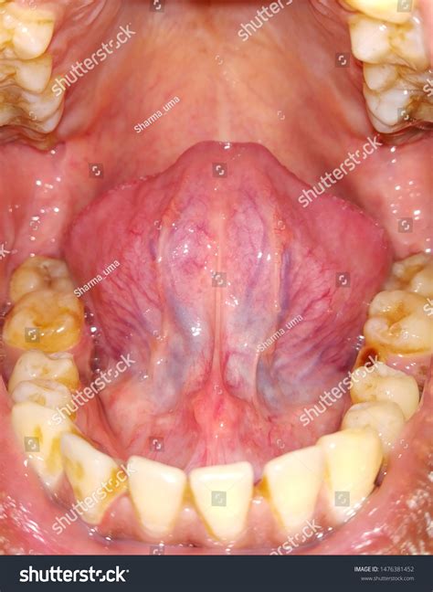 Closeup Tongue Showing Veins Blood Flow Stock Photo 1476381452 ...