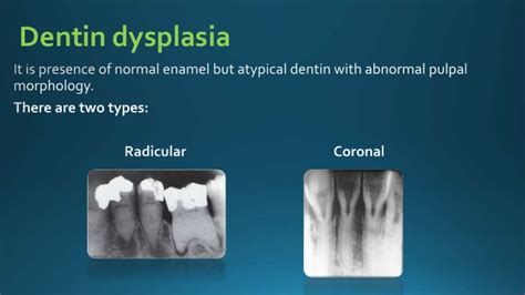 Dentin dysplasia