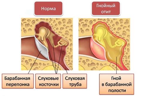 Purulent otitis in the child: causes, symptoms, treatment at home - Treat simply