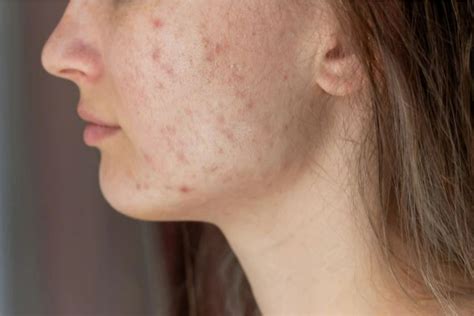 Difference Between Regular Acne And PCOS Induced Acne| And How to Cure Both| Expert Speaks|