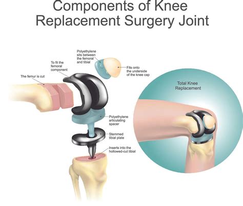 Total Knee Replacement (TKR) | Dr A. Theodorides Knee Surgeon Specialist