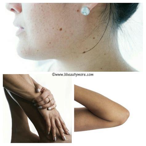 Hyperpigmentation: Skin Discoloration And Natural Remedies